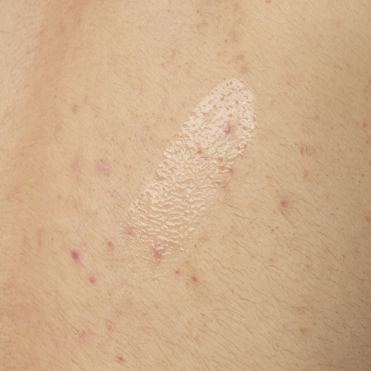 salicylic-acid-0-5-body-serum-f9 ORD-salicylic-acid-05-body-240ml-application.jpg