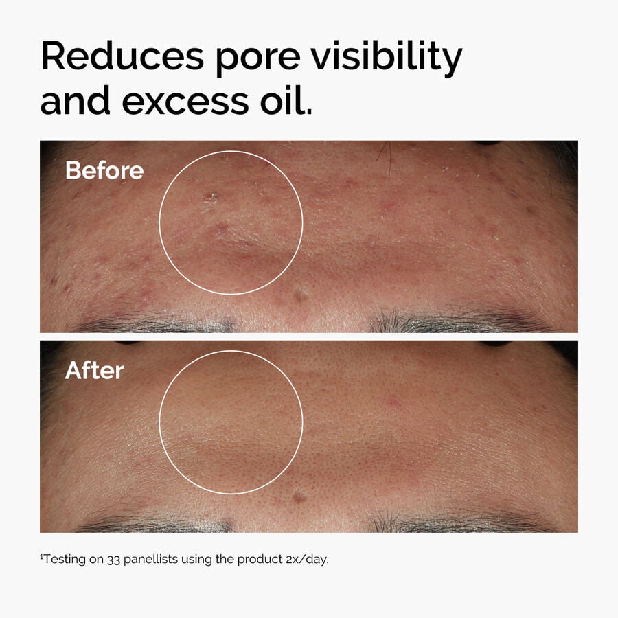niacinamide-10-zinc-1-y9 ord-niacinamide-zinc-blemish-serum-before-after-pores.jpg