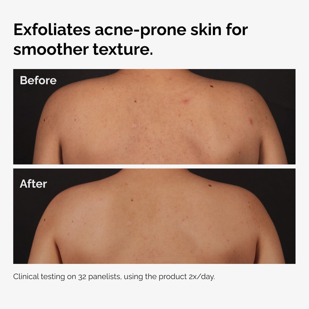 salicylic-acid-0-5-body-serum-f9 ord-salicylic-acid-body-serum-before-after-graphic-NA.jpg